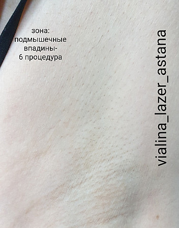 Лазерная эпиляция. АКЦИЯ Астана (Нур-Султан) - изображение 2