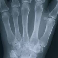 Рентгеновский снимок руки, показывающий кости