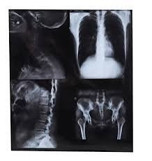 Комплексный рентгеновский снимок, включающий грудную клетку, позвоночник и таз