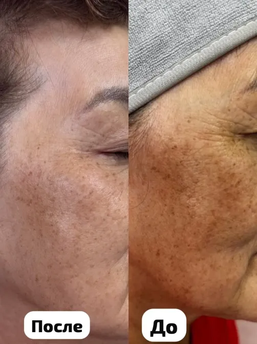 Изменение пигментации кожи, до и после