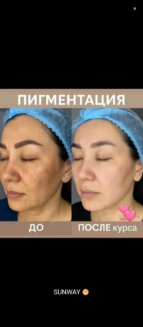 Изменение пигментации кожи до и после курса
