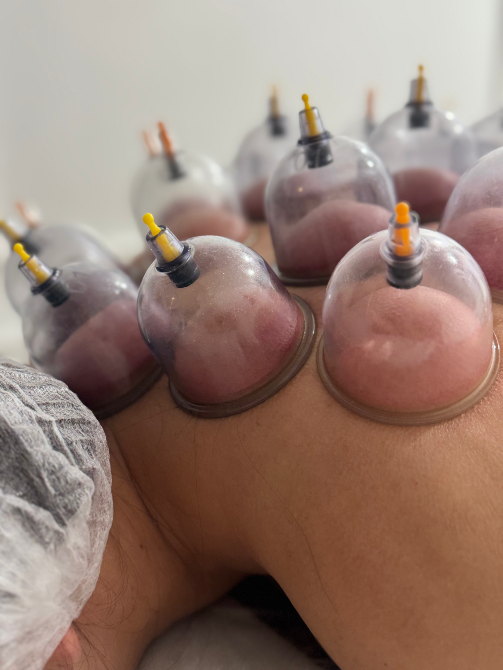 Эффект вакуумной терапии на спине пациента с банками