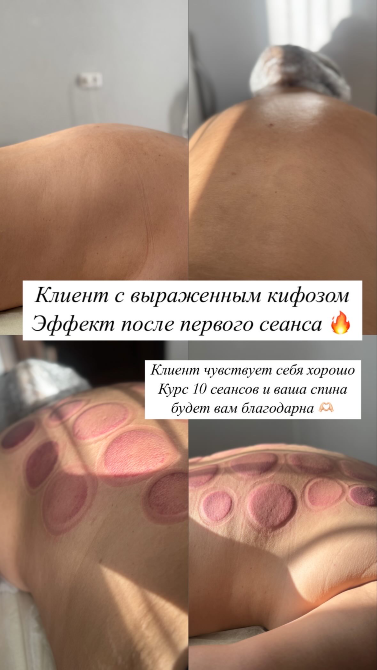 Клиент с кифозом до и после сеанса массажа, показано улучшение