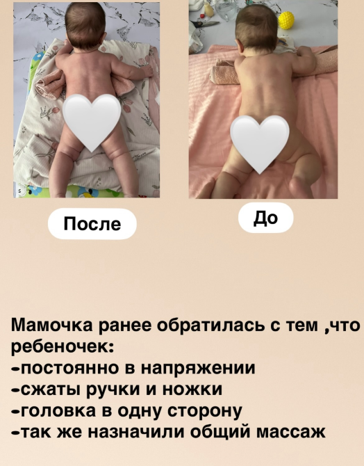 Балалар массажы туралы пікір, бала жағдайының жақсаруы, массажға дейін және кейінгі фото, 0-ден 5 жасқа дейінгі балаларға арналған массаж акциясы