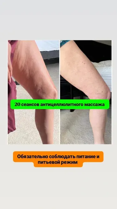 Изображение с результатами похудения и уменьшения объёмов после 20 сеансов