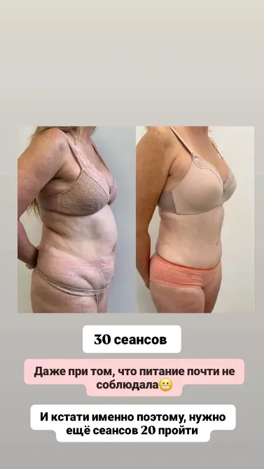 Изображение с изменениями фигуры после 30 сеансов