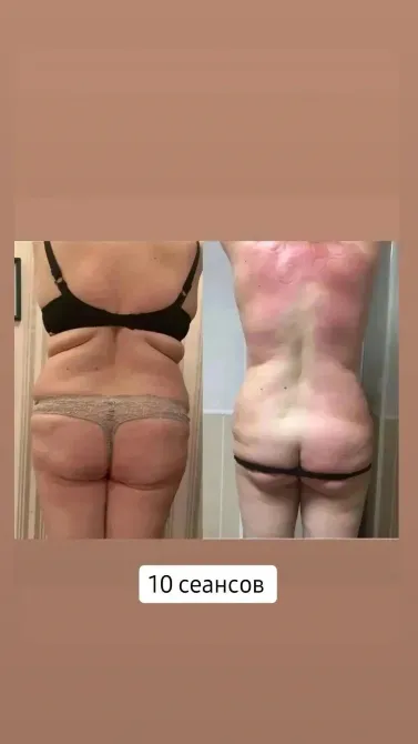 Изображение с результатами антицеллюлитного массажа после 10 сеансов