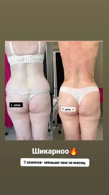 Изображение с результатами изменения тела после 7 сеансов