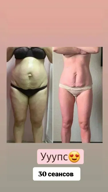 Изображение с результатами схуднения после 30 сеансов