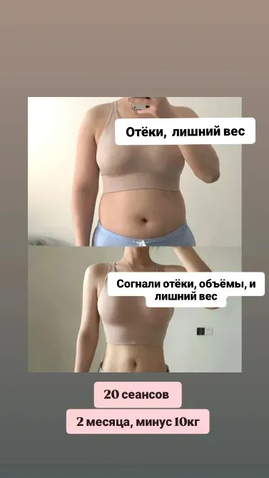 Изображение с результатами похудения и уменьшения отёков после 20 сеансов