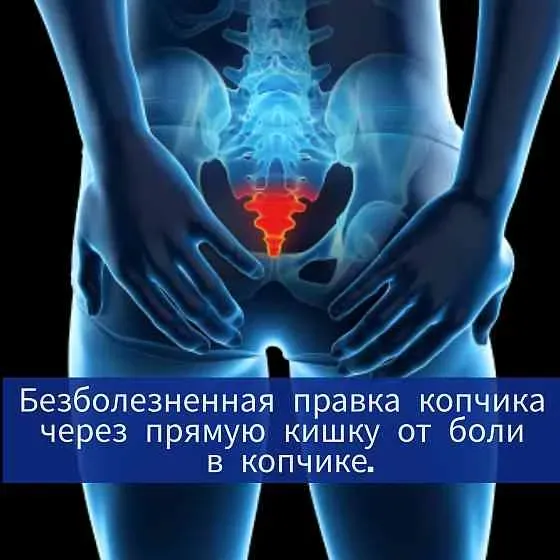 Анатомическая иллюстрация нижней части позвоночника с указанием причины боли в копчике и прямой кишке